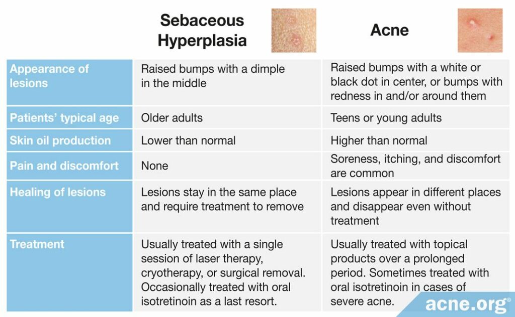 Sebaceous Hyperplasia and Acne Comparison Chart