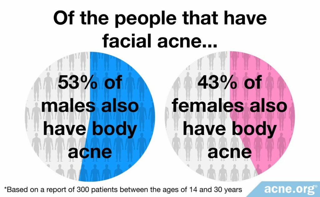 53% of males with facial acne and 43% of females with facial acne also have body acne