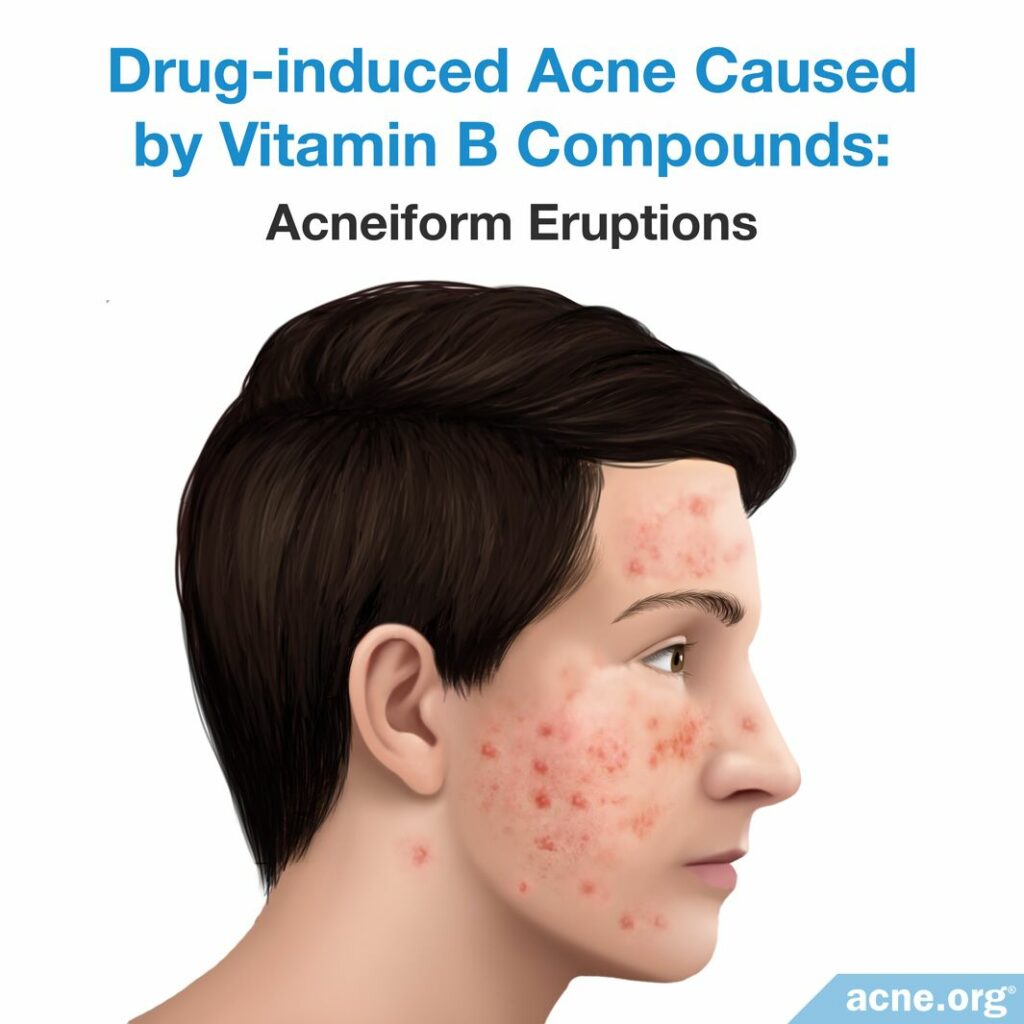 Drug-induced Acne Caused by Vitamin B Compounds