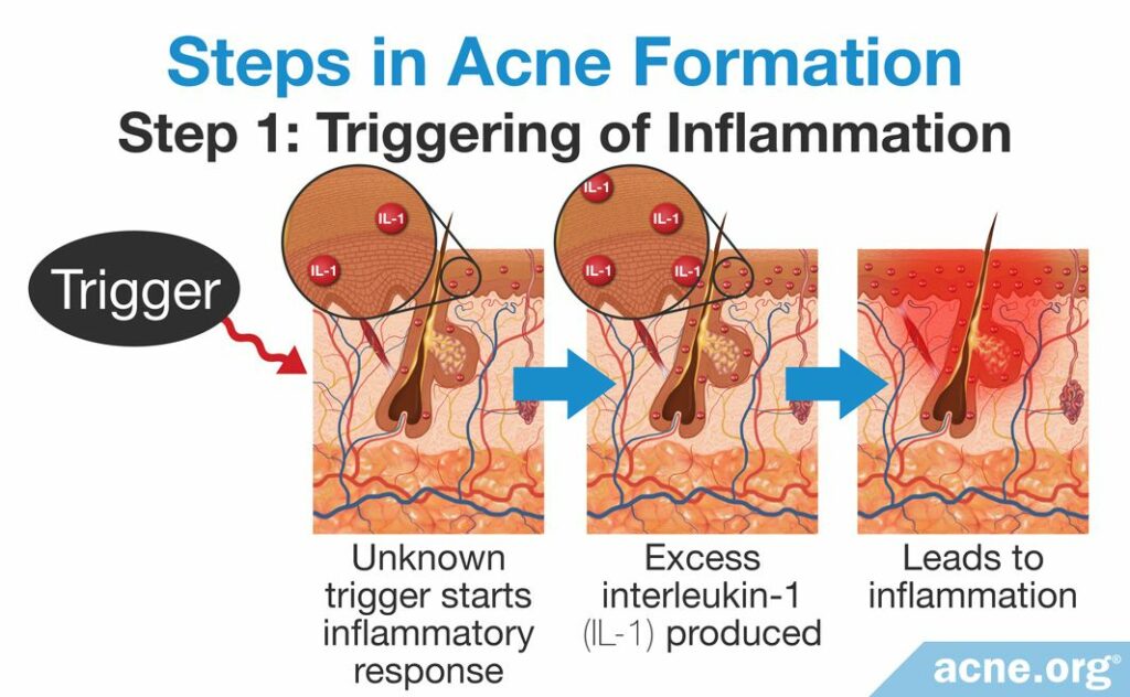 Steps in Acne Formation Step 1 Triggering of Inflammation
