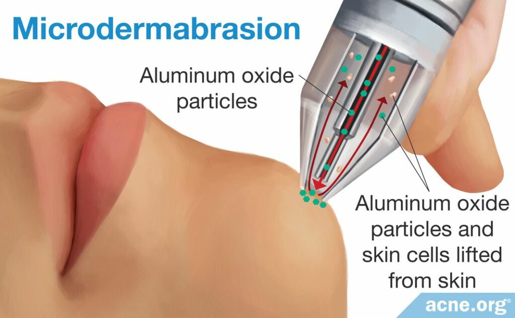 Microdermabrasion