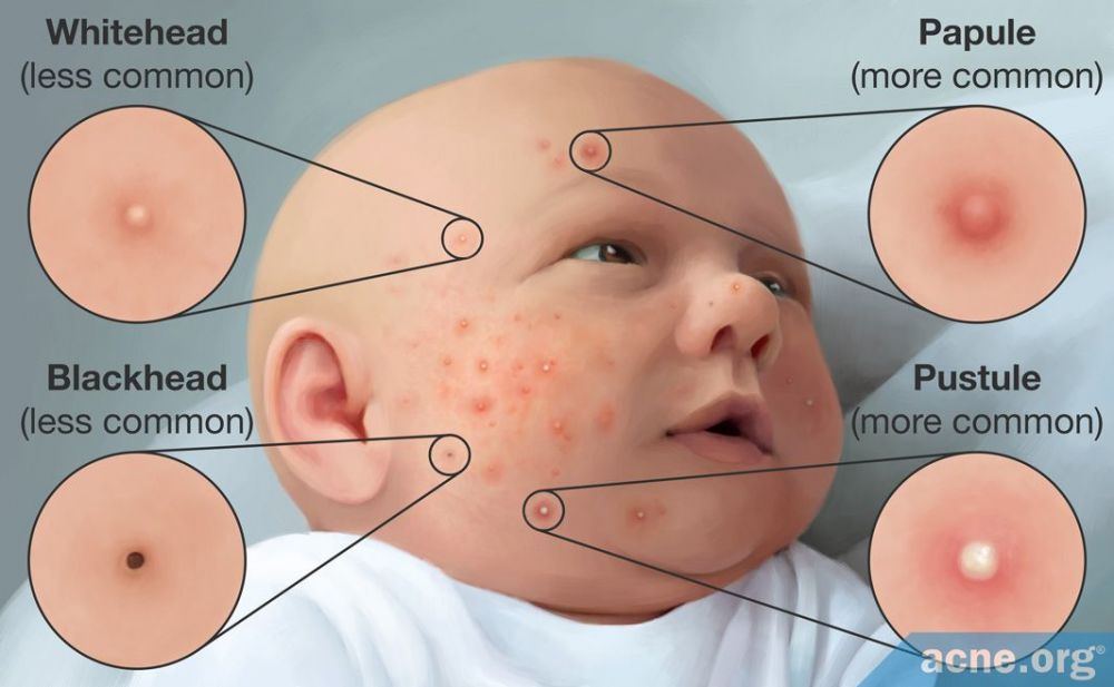 Baby Acne Whitehead Blackhead Papule Pustule