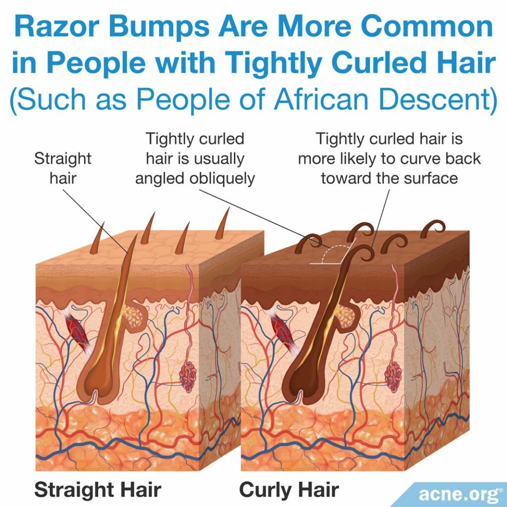 Razor Bumps Are More Common in People with Tightly Curled Hair
