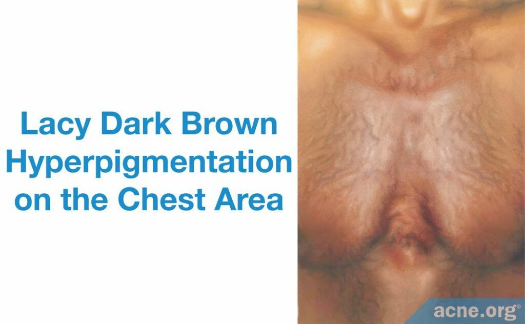 Lacy Dark Brown Hyperpigmentation on the Chest Area