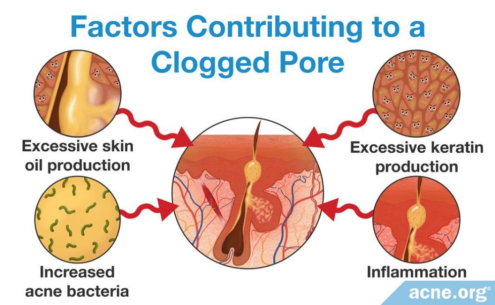 Factors Contributing to a Clogged Pore