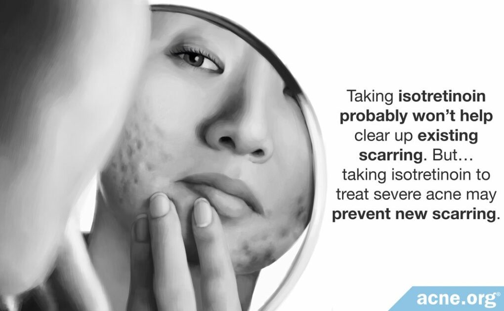 Does Isotretinoin Help with Acne Scars?