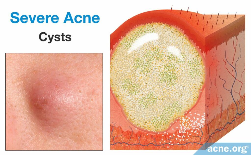 Severe Acne Cysts