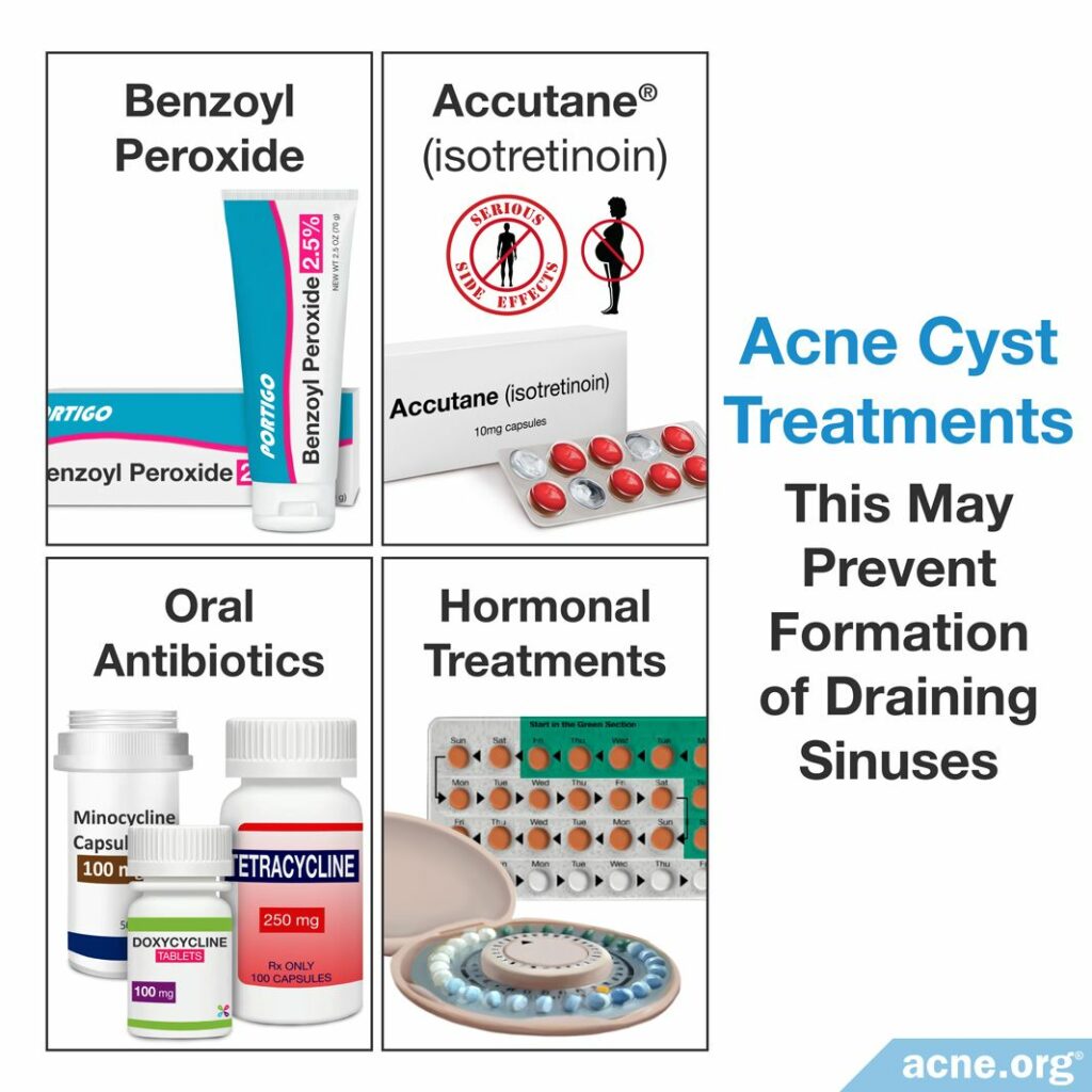 Acne Cyst Treatments