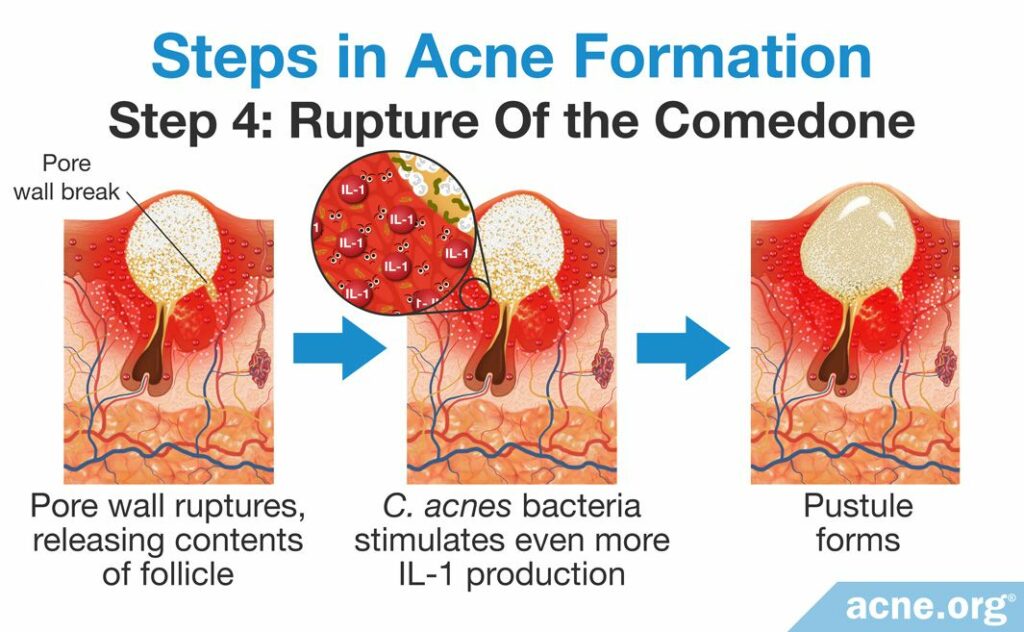 Steps in Acne Formation Step 4 Rupture of the Comedone