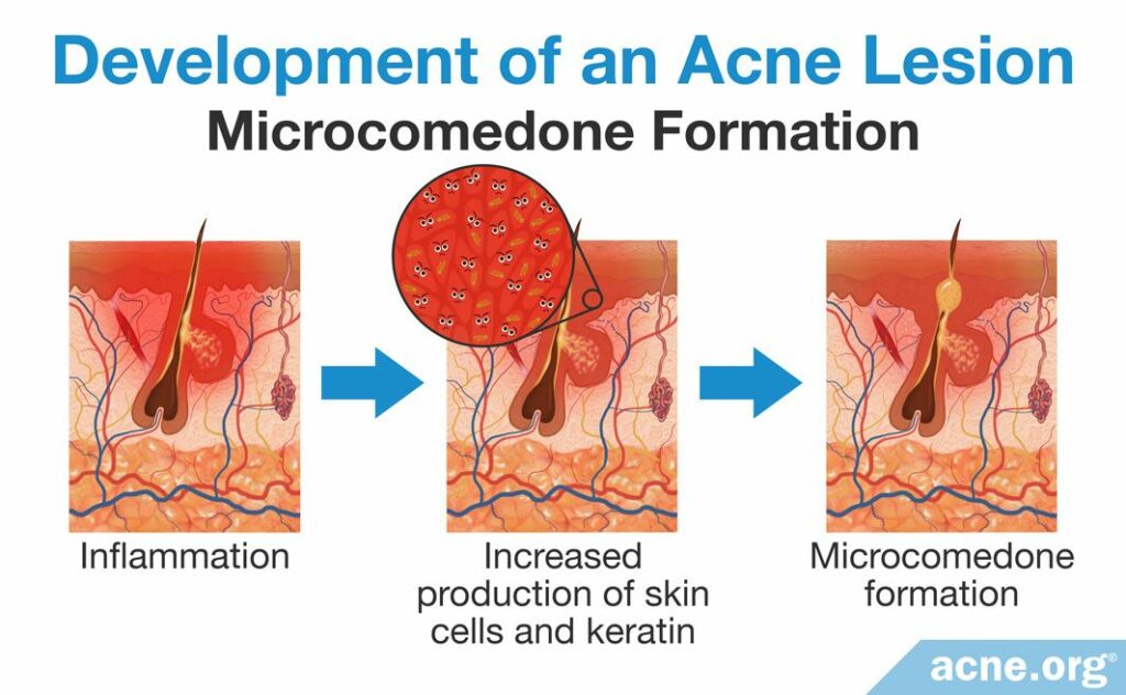 Development of an Acne Lesion Microcomedone Formation