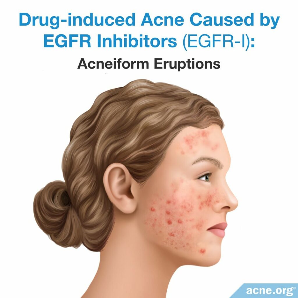 Drug-induced Acne Caused by EGFR Inhibitors EGFR-1