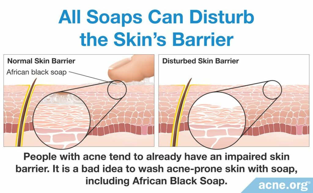All Soaps Can Disturb the Skin's Barrier