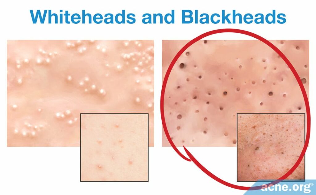 Whiteheads and Blackheads