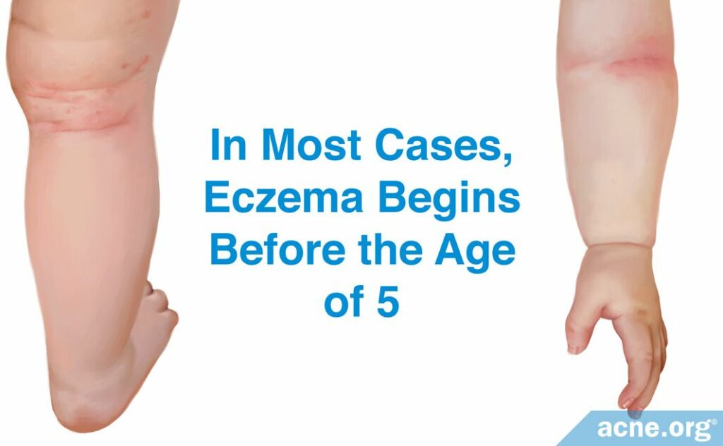 In most cases, eczema begins before the age of 5.