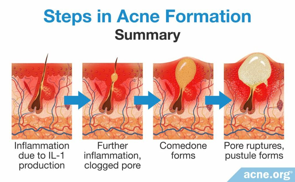 Steps in Acne Formation Summary