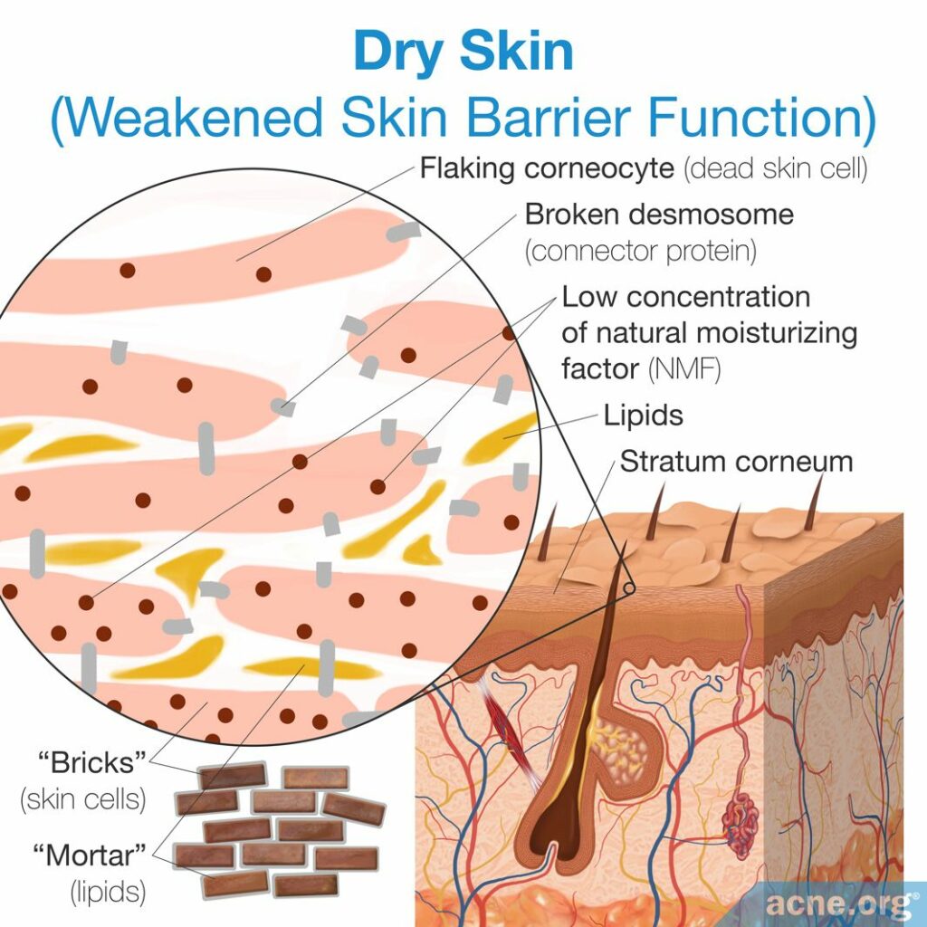 Dry Skin with a Weakened Skin Barrier Function