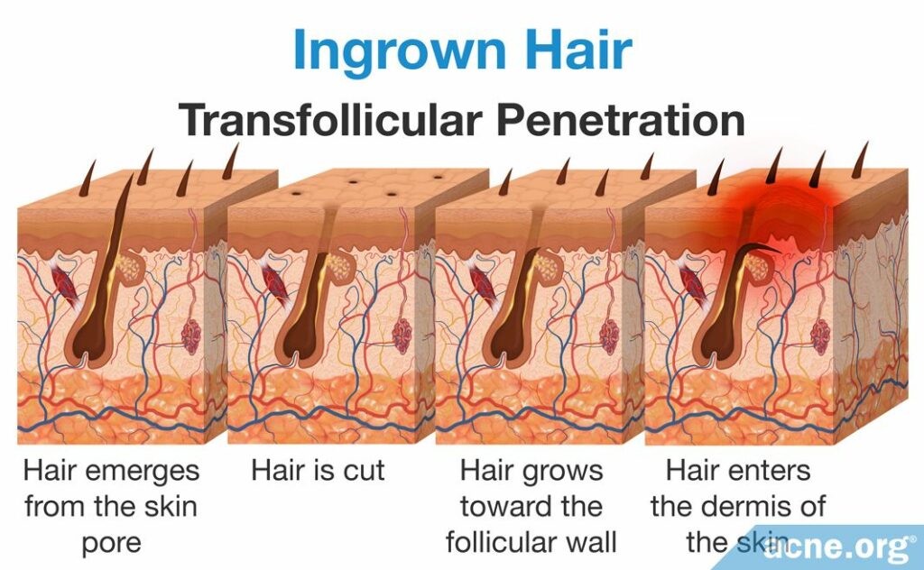 Ingrown Hair Transfollicular Penetration