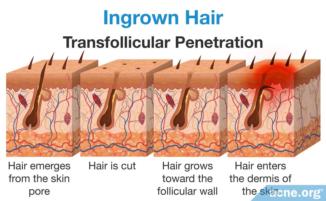 What Are Ingrown Hairs? 
