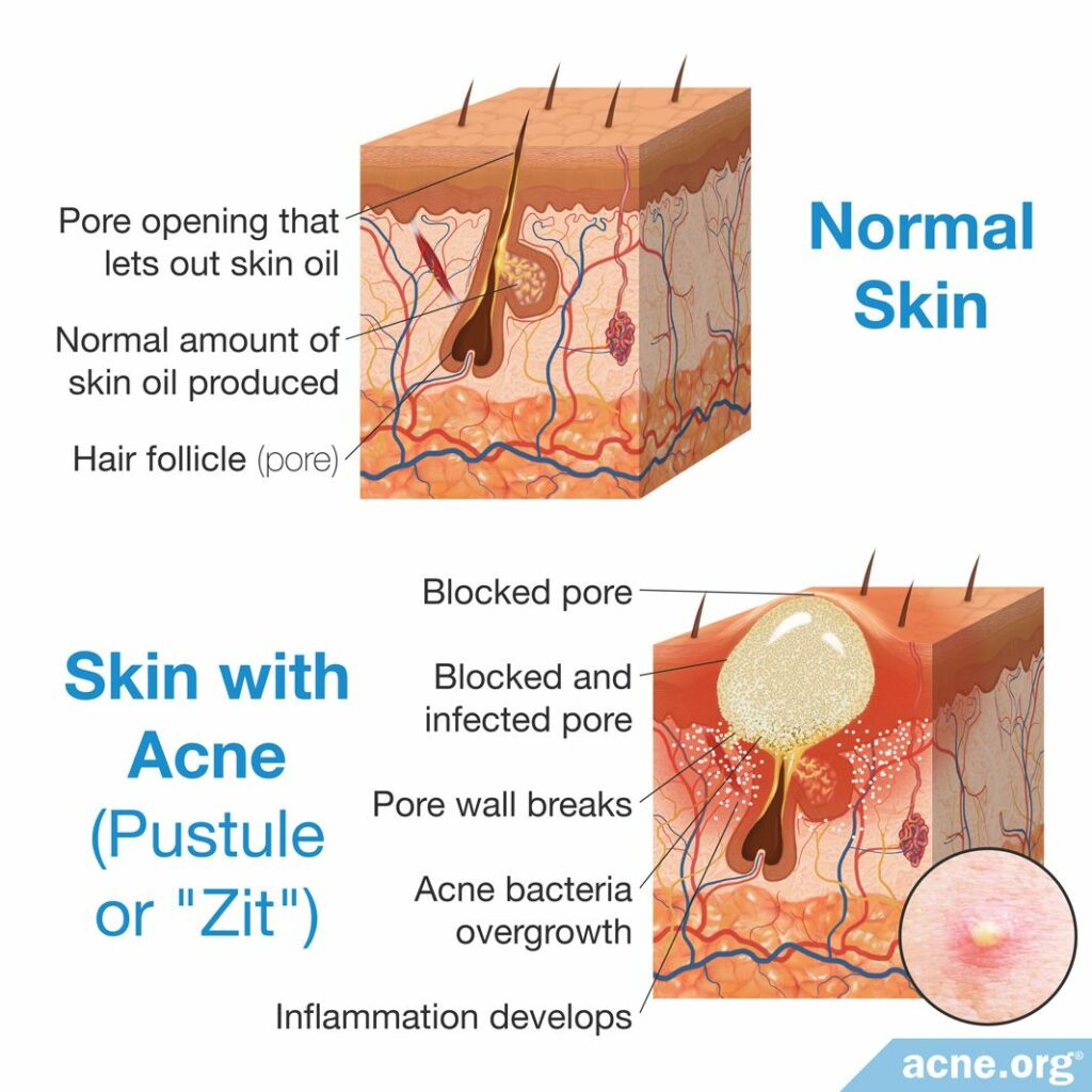 Normal Skin and Skin with Acne