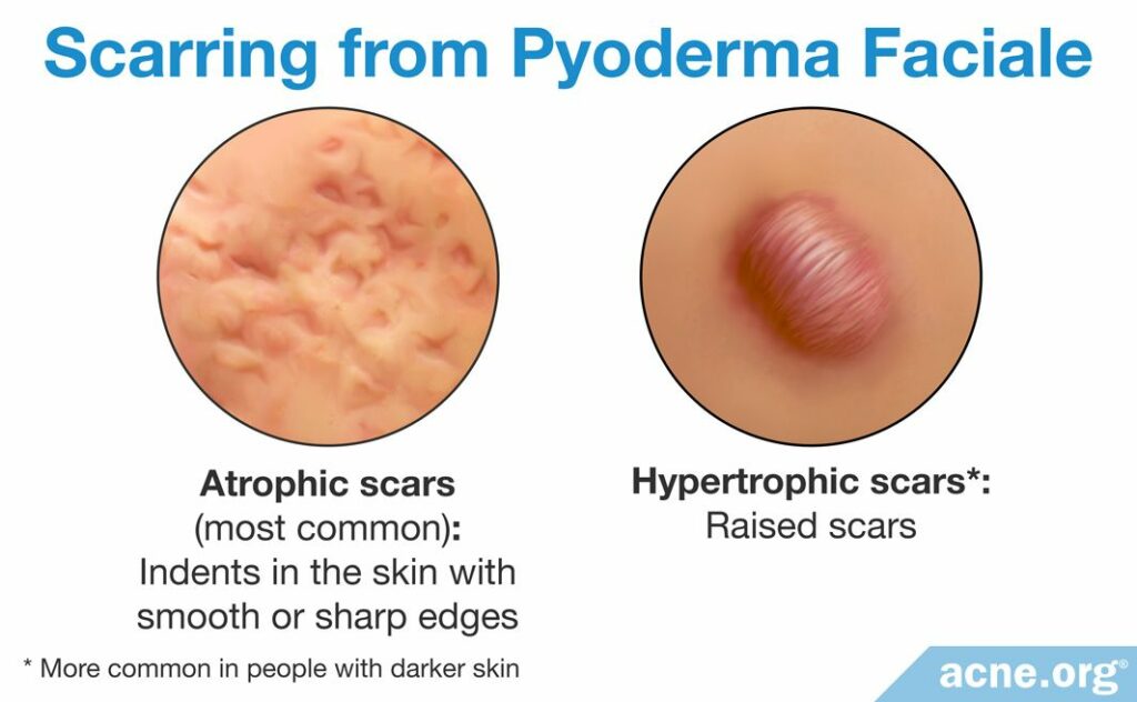 Scarring from Pyoderma Faciale