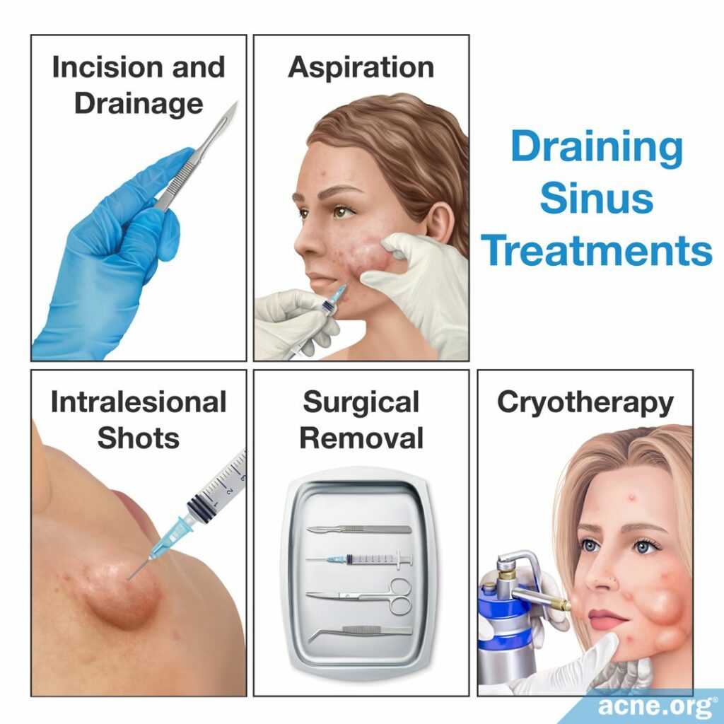 Draining Sinus Treatments
