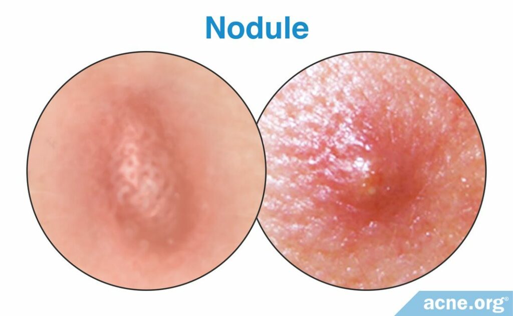 Nodule