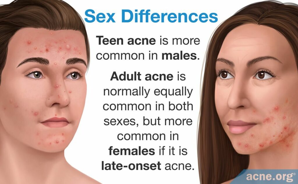 Sex Differences in Teen and Adult Acne