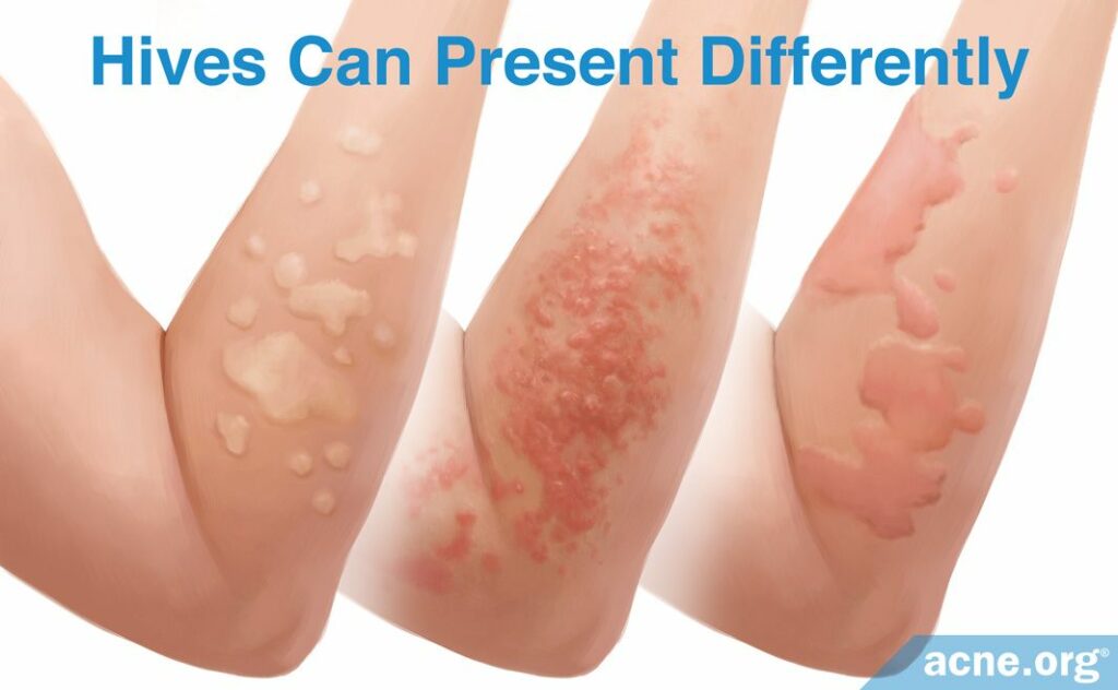 Hives Can Present Differently