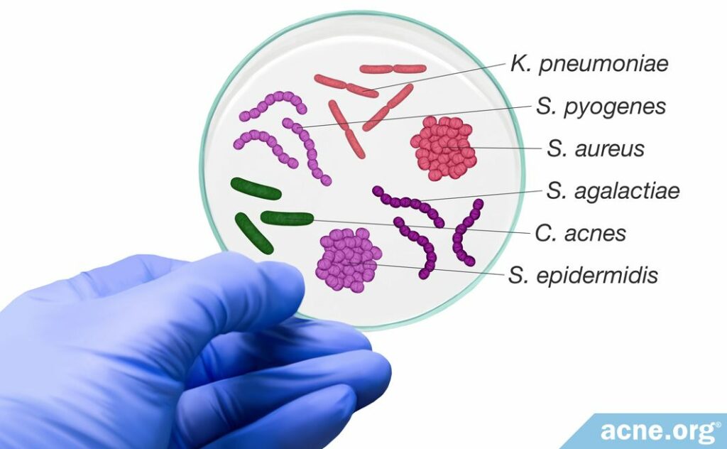 Petri Dish with Bacteria Associated with Acne