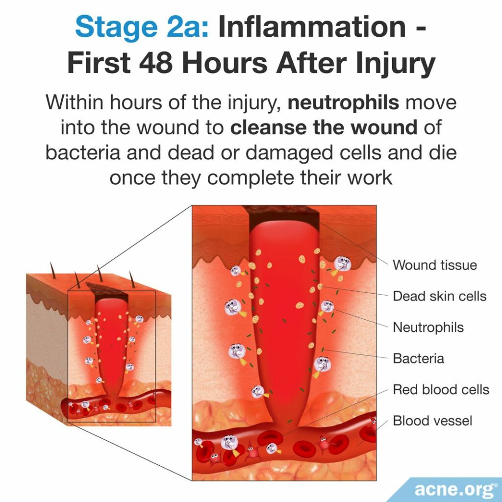 Stage 2a - Inflammation - First 48 Hours After Injury