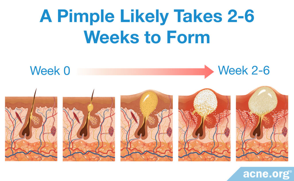The Steps It Takes for A Pimple to Form from Week 0 Normal Pore to Week 2 to 6 Pimple