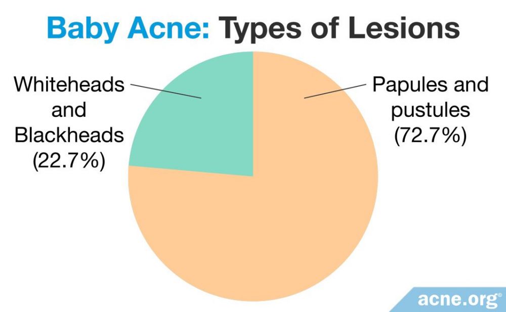 baby Acne Types of Lesions