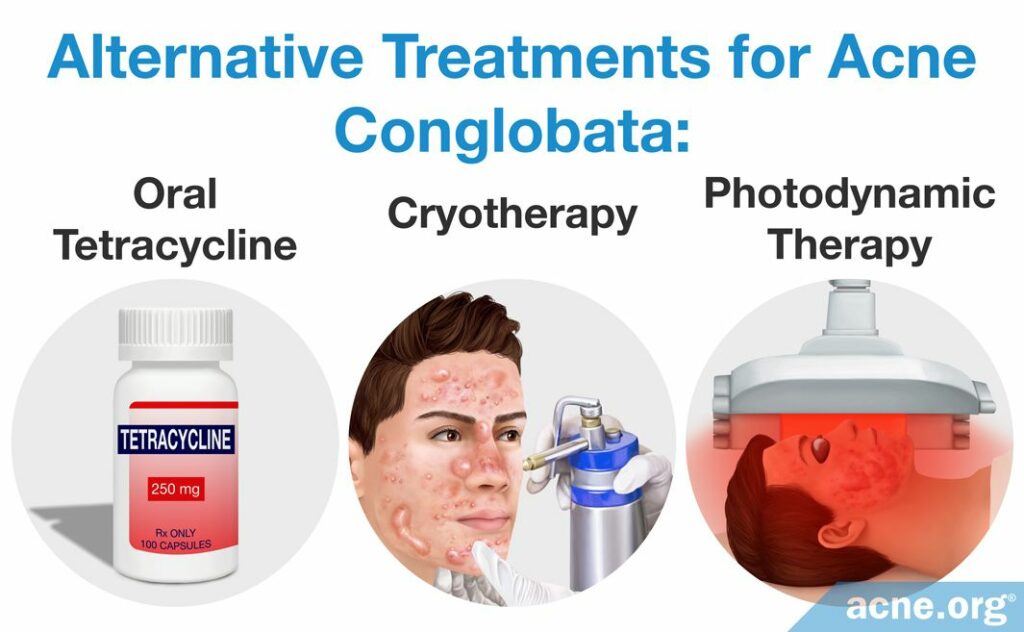 Alternative Treatments for Acne Conglobata