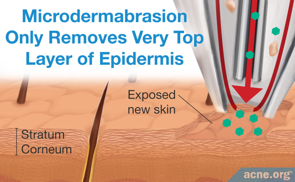 Microdermabrasion Only Removes Very Top Layer of Epidermis