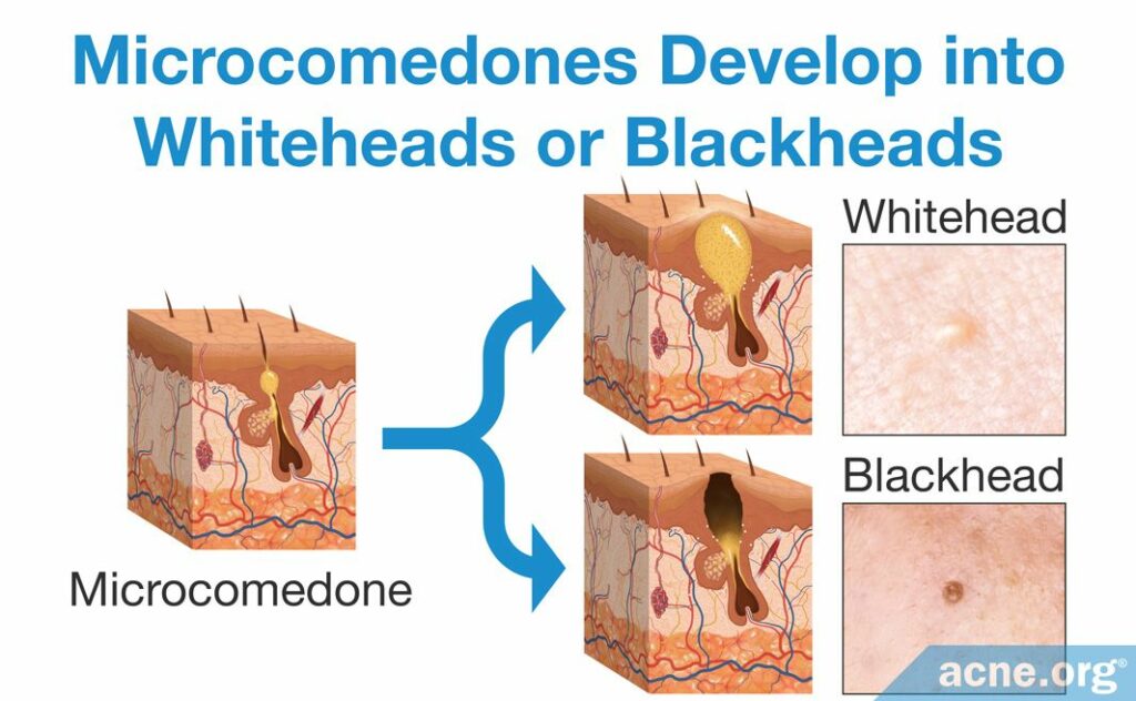 Microcomedones Develop into Whiteheads or Blackheads