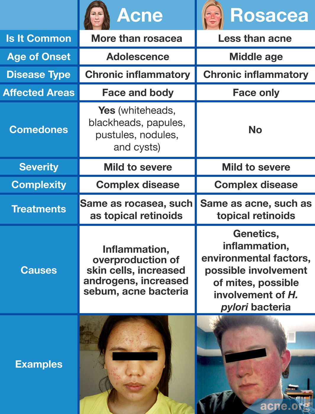 Acne and Rosacea Characteristics