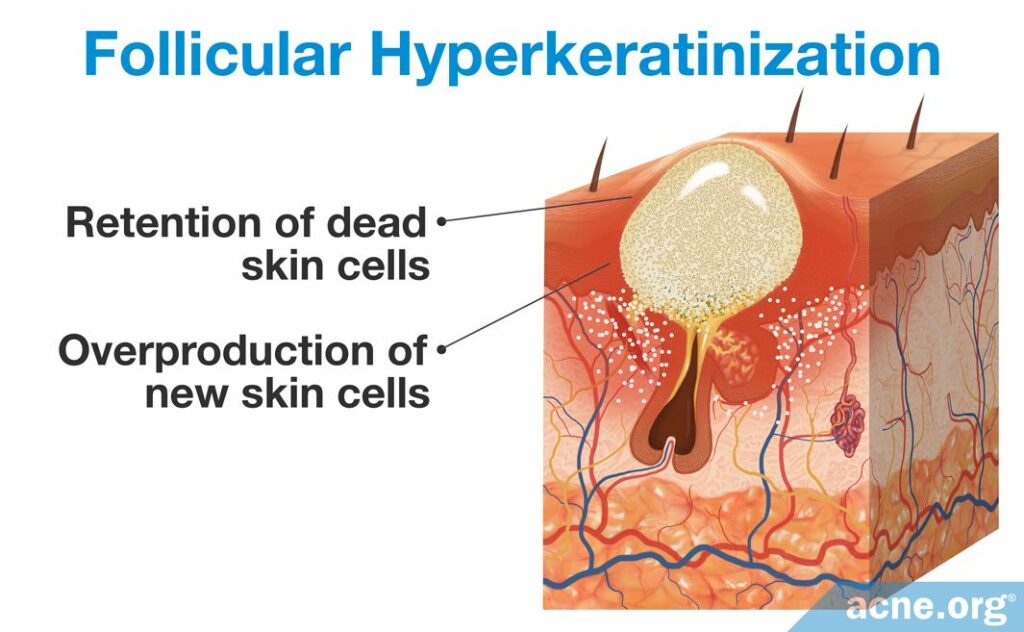 Follicular Hyperkeratinization