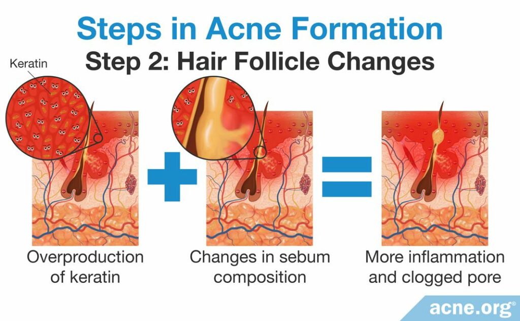 Steps in Acne Formation Step 2 Hair Follicle Changes