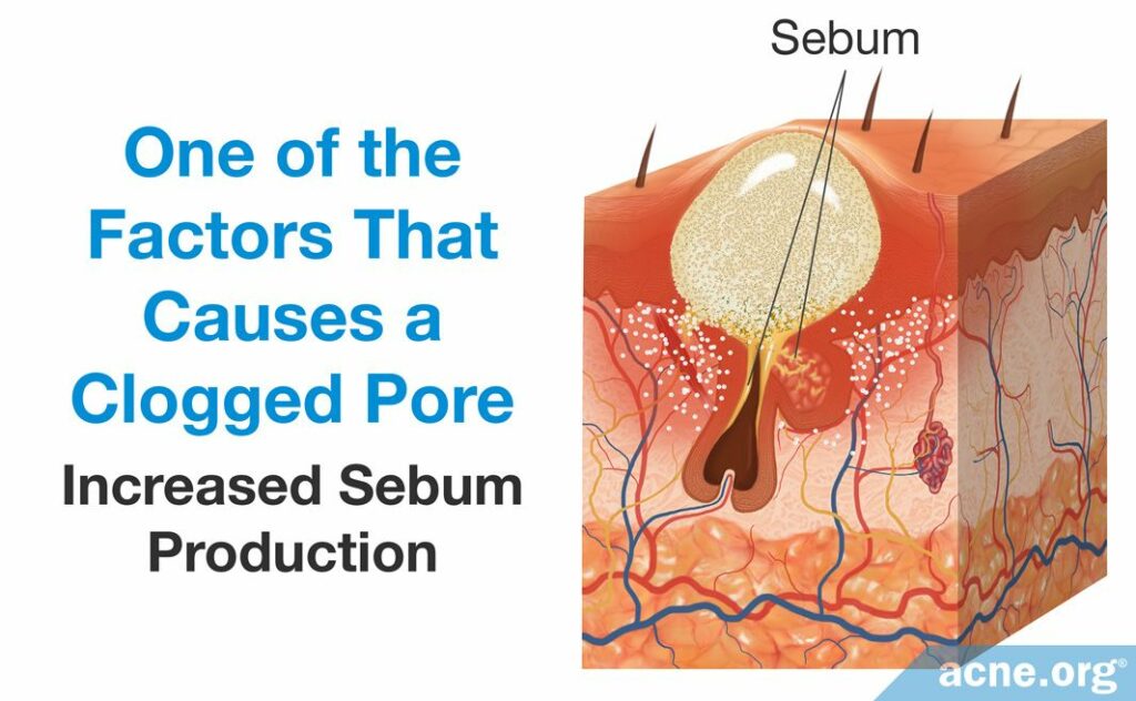 Increased Sebum Production Causes a Clogged Pore