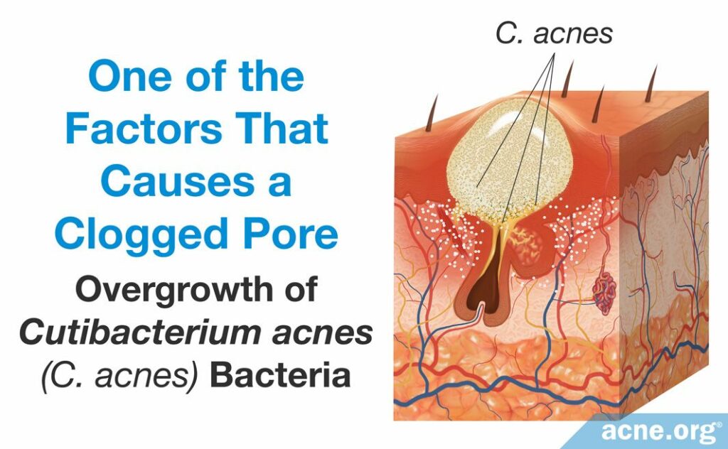 One of the Factors That Causes a Clogged Pore - Overgrowth of Cutibacterium acnes C. acnes Bacteria