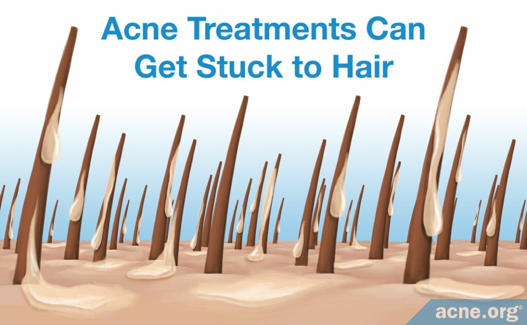 Acne Treatments Can Get Stuck to Hair