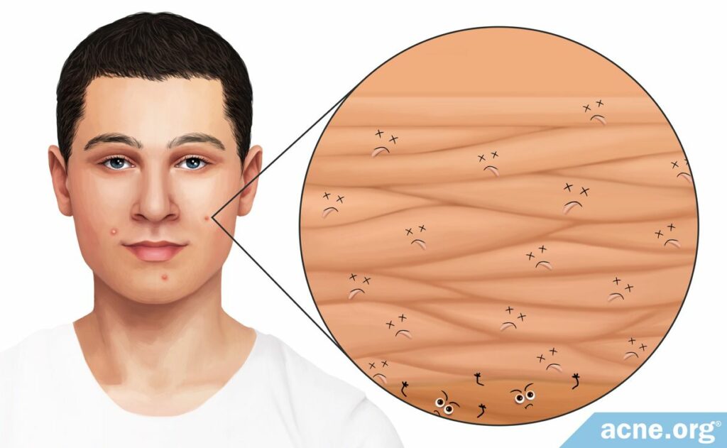 Acne Indepth How Dead Skin Cell Accumulation Can Lead to Acne