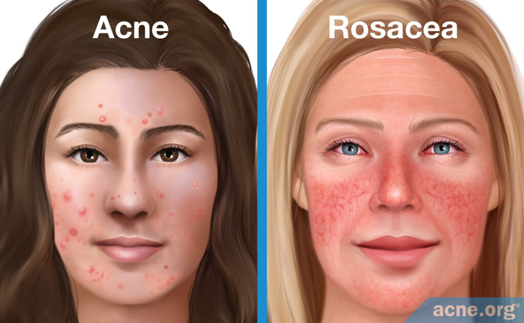 Acne Vs Rosacea