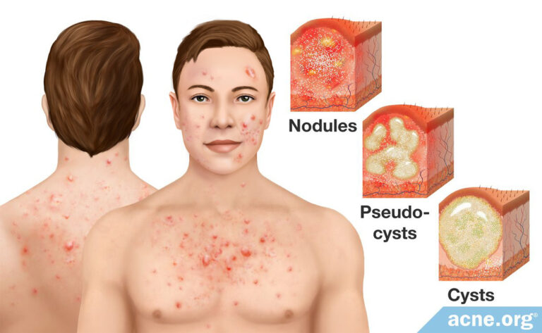 Cystic Acne Archives Acne