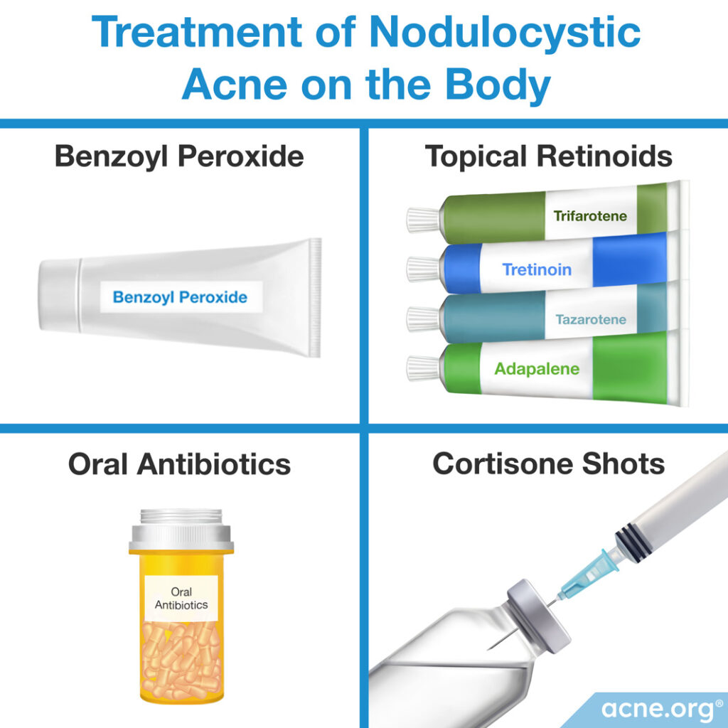 Treatment of Nodulocystic Acne on the Body