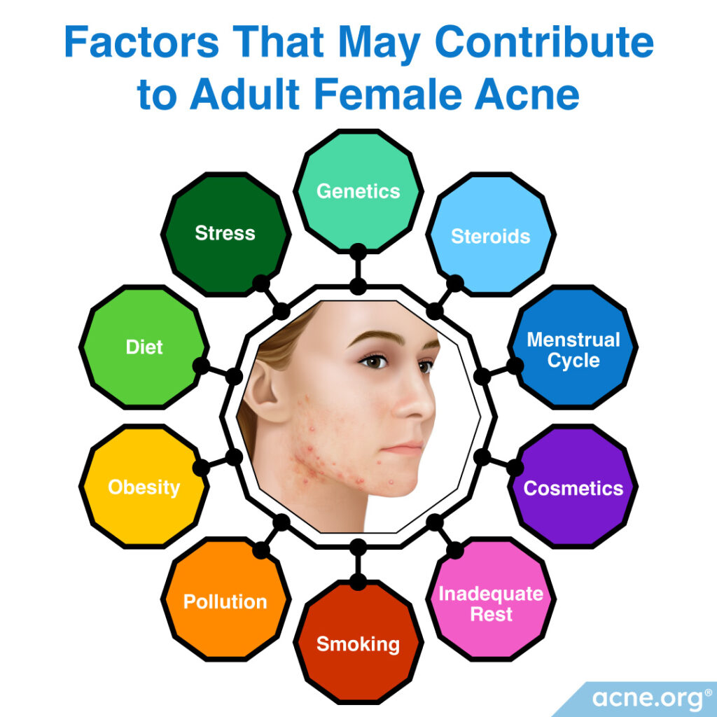 Factors That May Contribute to Adult Female Acne
