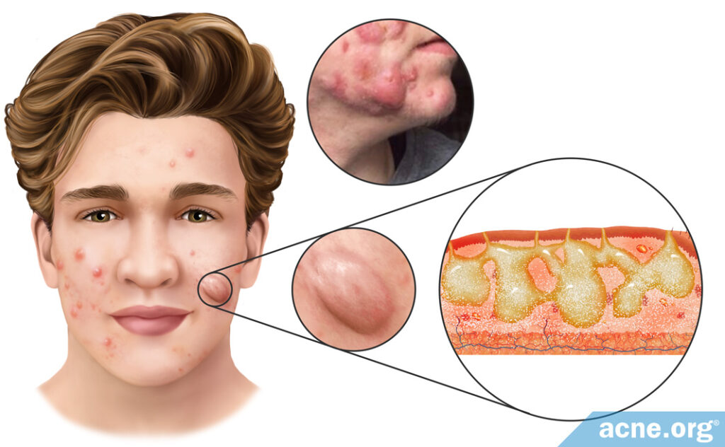What Is a Draining Sinus?