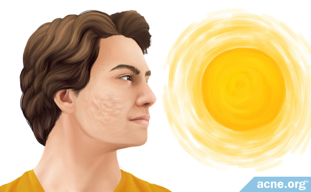 Does Sun Exposure Make Acne Scars Worse?