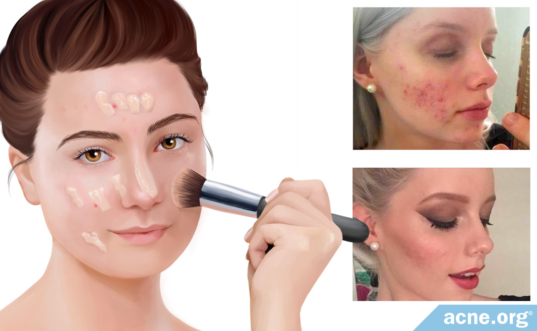 Does Makeup Help with Self-esteem When Have Acne.org