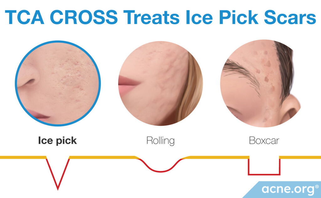 TCA CROSS Treats Icepick Scars